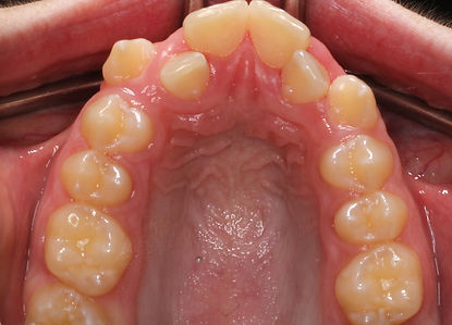 Case 11 before treatment