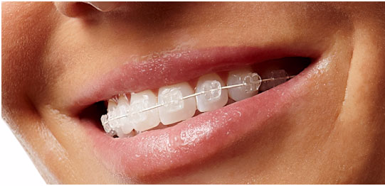 Clear Braces