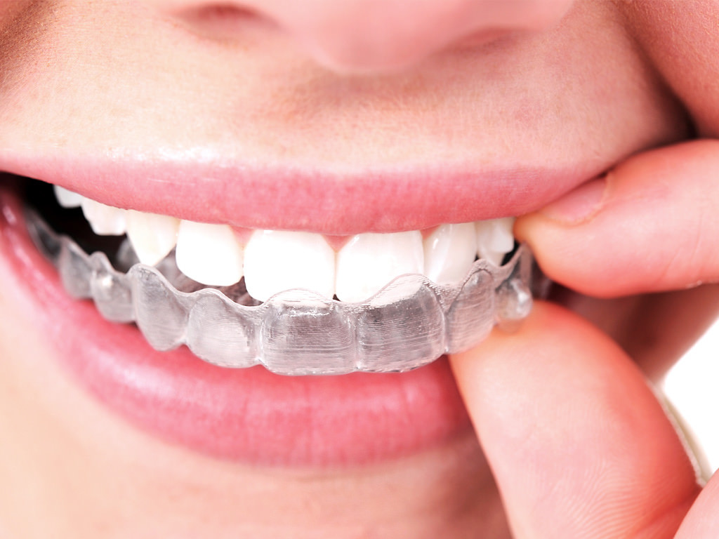 Invisible Braces Invisalign
