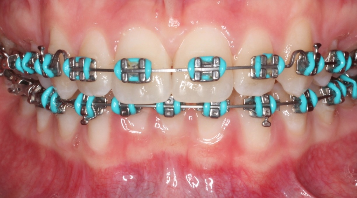 Metal Braces